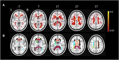 The Spatial Associations of Cerebral Blood Flow and Spontaneous Brain Activities with White Matter Hyperintensities—An Exploratory Study Using Multimodal Magnetic Resonance Imaging